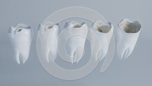 The stages of caries on the molar - 3D Rendering