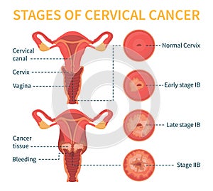 Stages of cervical cancer vector white scheme
