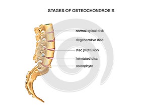 Stages of degenerative disc disease