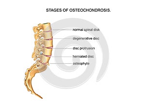 Stages of degenerative disc disease photo