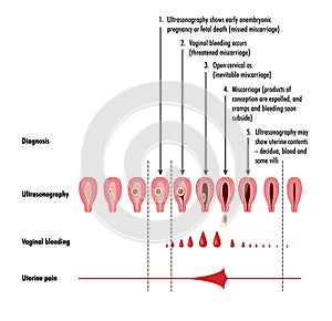 Stages and detection of miscarriage