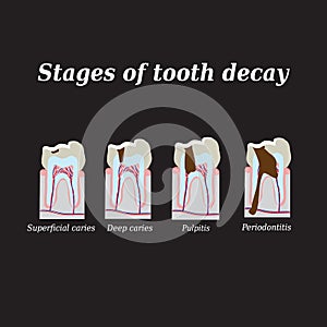 Stages of development of dental caries. Vector