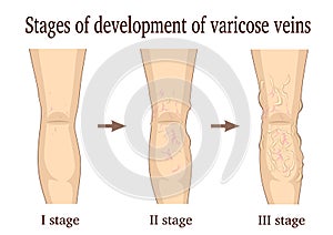 Stages of development of varicose veins