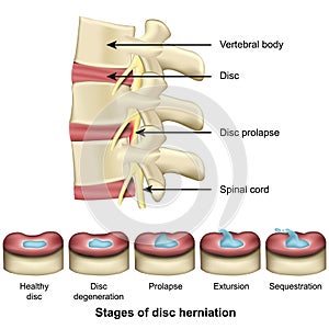 Stages of disc herniation spine and disc anatomy 3d medical vector illustration photo