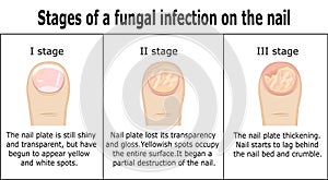 Stages of a fungal infection on the nail