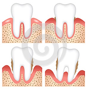 Stages of gum disease infographic illustration. dental and oral care concept photo