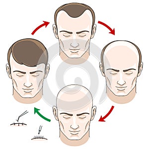 Stages of hair loss, treatment and transplantation photo