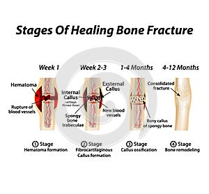 Stages Of Healing Bone Fracture. Formation of callus. The bone fracture. Infographics. Vector illustration on isolated