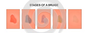 Stages of healing of a bruise