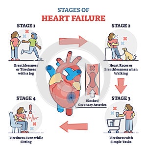 Stages of heart failure and symptoms with cardiology stroke outline diagram