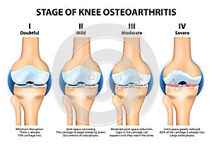 Stages of knee Osteoarthritis (OA).