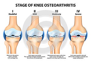 Progreso de rodilla artrosis ()  