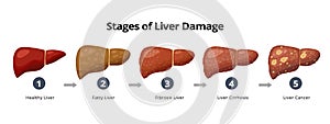 Stages of liver damage from healthy, fatty liver, fibrosis, cirrhosis to liver cancer. Medical infographic, liver