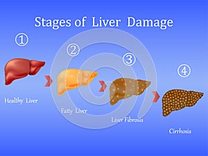 Stages of liver damage, liver disease. Healthy, fatty, liver fibrosis and cirrhosis on blue background.Vector illustratio