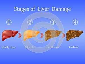 Stages of liver damage, liver disease. Healthy, fatty, liver fibrosis and cirrhosis on blue background.Vector illustratio