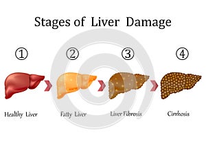 Stages of liver damage, liver disease. Healthy, fatty, liver fibrosis and cirrhosis isolated on white background.Vector illustrati