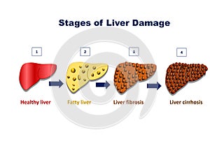 Stages of liver damage, liver injury fatty liver, liver fibrosis, liver cirrhosis