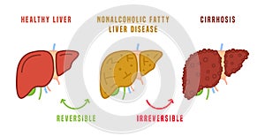 Stages of liver diseases. Medical infographic. Vector illustration photo