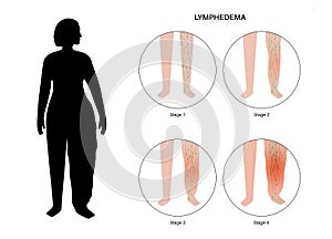 Stages of lymphedema photo