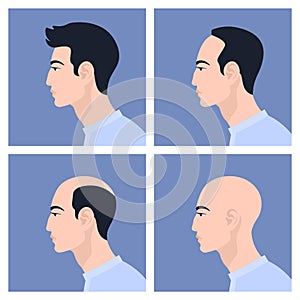 Stages of male pattern baldness. Hair loss. Alopecia.