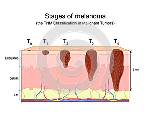 Stages of melanoma. The TNM Classification of Malignant Tumors photo