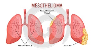 Stages of mesothelioma, lung disease. Healthcare. Medical infographic banner, illustration