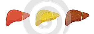 Stages of nonalcoholic liver damage. Healthy, fatty and cirrhosis. Liver Disease.