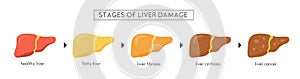 Stages of nonalcoholic liver damage. Healthy, fatty, steatosis, NASH, fibrosis, cirrhosis, cancer. Medical infographic
