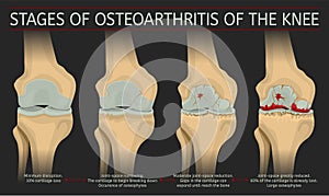 Stages of osteoarthritis of the knee