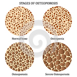 Stages of osteoporosis.