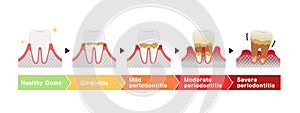 The stages of periodontitis disease illustration