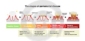 The stages of periodontitis disease illustration