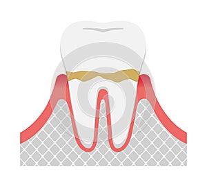 The stages of periodontitis disease illustration  / Gingivitis