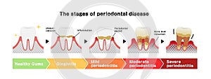 The stages of periodontitis disease illustration