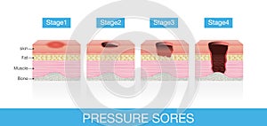 Stages of Pressure Sores