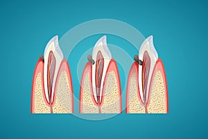 Stages progress caries on human canine