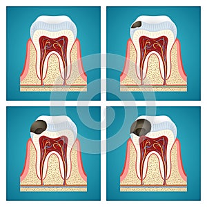 Stages progress caries on human teeth