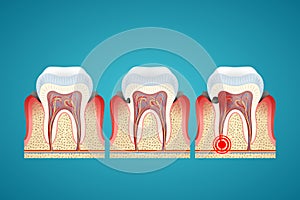 Stages progress caries on human teeth and disease gum