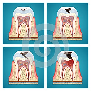 Stages progress dental caries