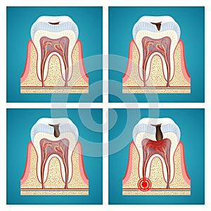 Stages progress dental caries