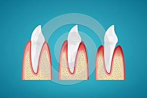 Stages progress disease gum on human canine