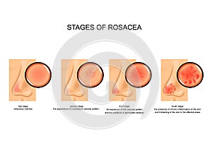 Stages of rosacea