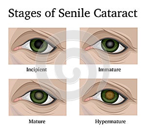 Stages of Senile Cataracts photo
