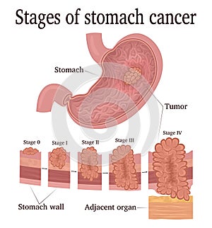 Stages of stomach cancer photo