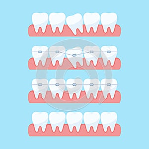 Progresso denti allineamento 