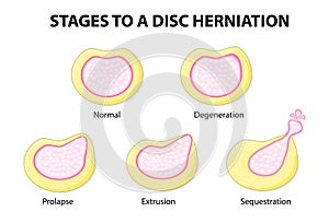 Stages to a disc herniation photo