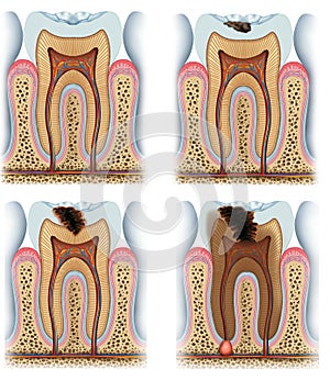 Stages of tooth caries