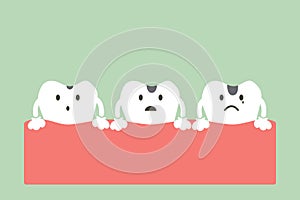 Stages of tooth decay