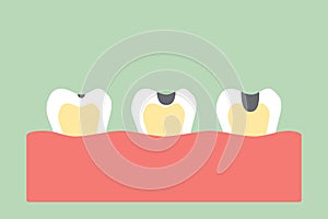 Stages of tooth decay