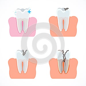 Stages of tooth decay with caries. Dentistry and oral care